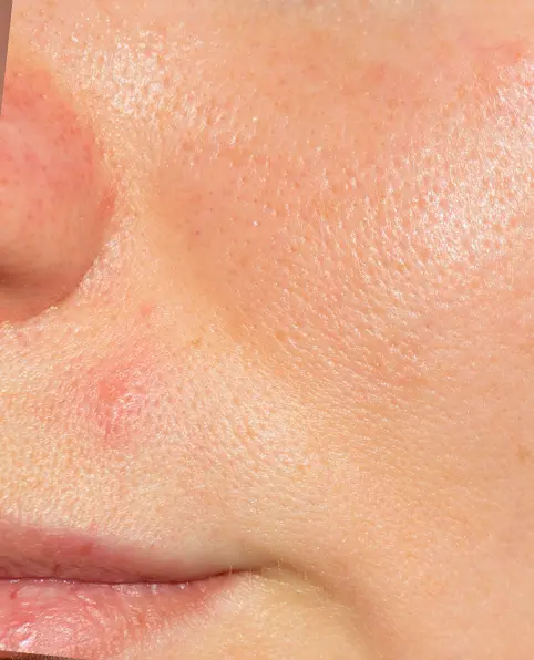 Close-up of human skin on the face, highlighting pores, subtle redness, and a small blemish before using aveseena gentle gardenia facial gel cleanser. The skin texture is clearly visible, conveying a natural look.