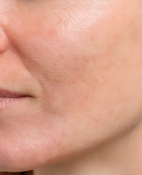 Close-up of a woman's cheek with visible skin texture and fine lines and wrinkles.