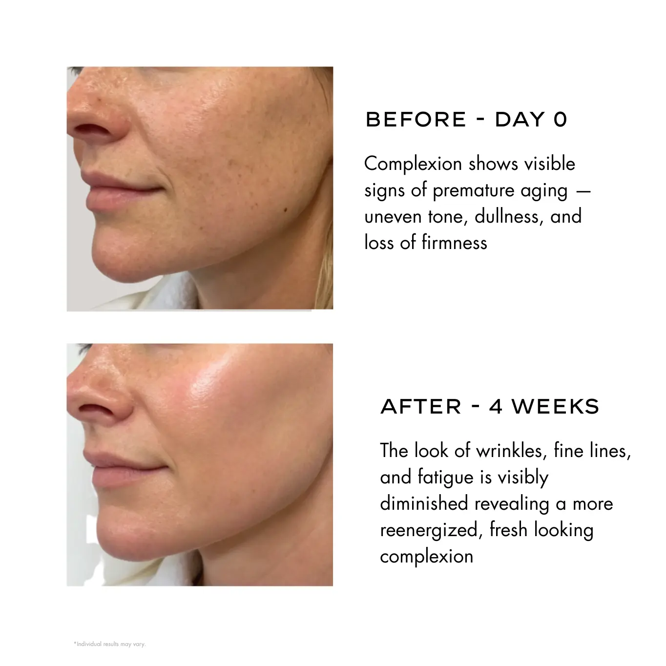 APC-5.webp "Two side-by-side images of a woman's cheek and jawline. Left: 'Before - Day 0' shows dull, uneven skin. Right: 'After - 4 Weeks' reveals smoother, radiant complexion."