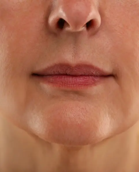 After 10 minutes ANKA treatment showing visibly lifted skin with enhanced firmness