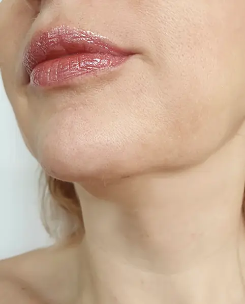 After 10 minutes ANKA treatment showing reduced puffiness and sculpted appearance