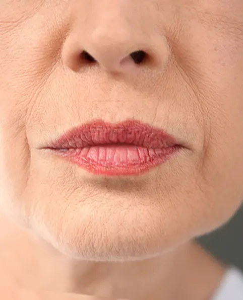 After 10 minutes ANKA treatment showing improved visible firmness and radiance
