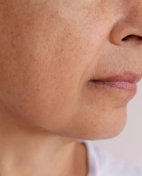 After 5 minutes ANKA LED treatment showing visibly toned and lifted skin