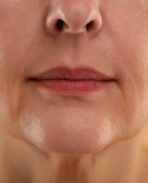 Before ANKA LED face treatment showing skin laxity