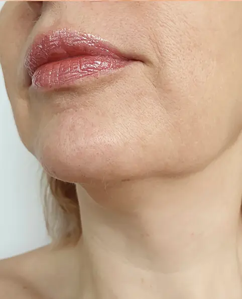 Before ANKA device treatment showing puffiness around face skin having pores sagging and wrinkles