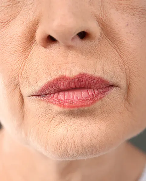 Before ANKA face treatment showing facial contour baseline with skin wrinkles pores rough texture