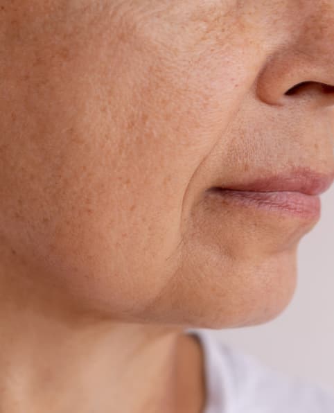 Before ANKA LED treatment showing skin on one side of face skin with wrinkles fine lines uneven tone