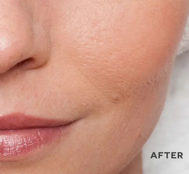 Close-up of skin after ANKA LED light treatment showing smooth and reduced appearance of blemishes.