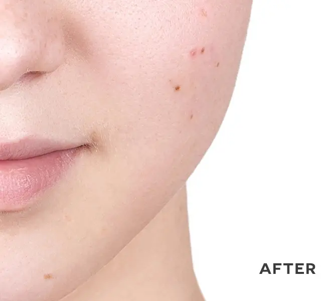 Skin close-up with improved texture and clarity after ANKA treatment