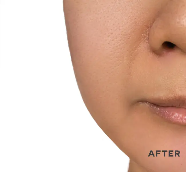 Close-up of revitalized skin showing visible improvement in tone and texture after using ANKA Led light skincare device.