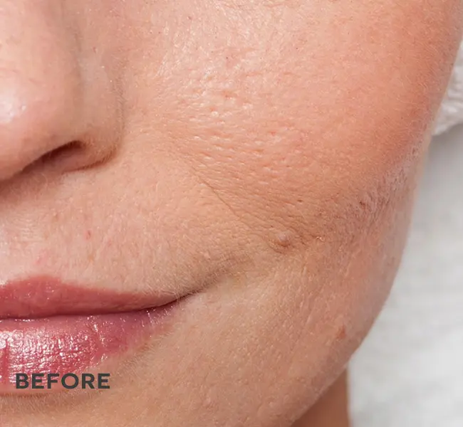 Before ANKA LED skin treatment baseline close up of skin with pores and fine lines and sigs of aging