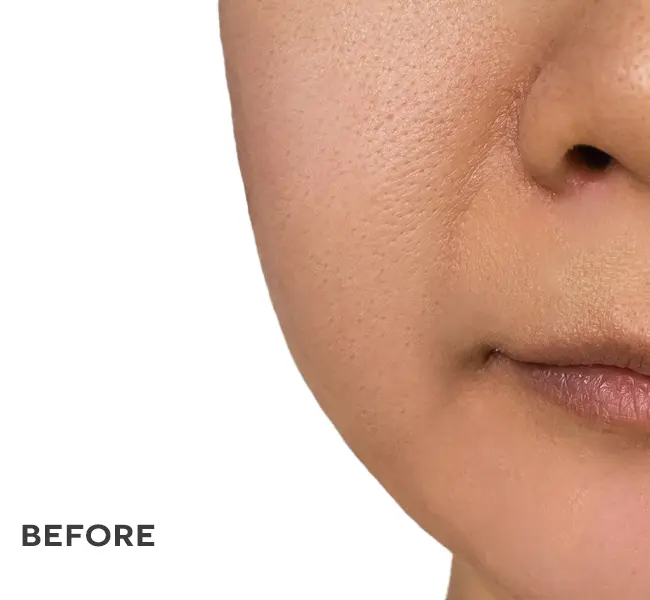 Close-up of skin showing before treatment condition with visible texture and fine lines.